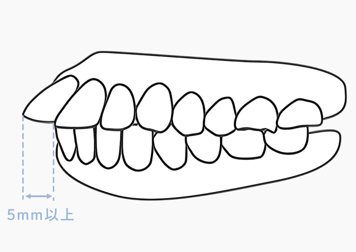 上の前歯が下の前歯よりも5mm以上前に突き出ている図